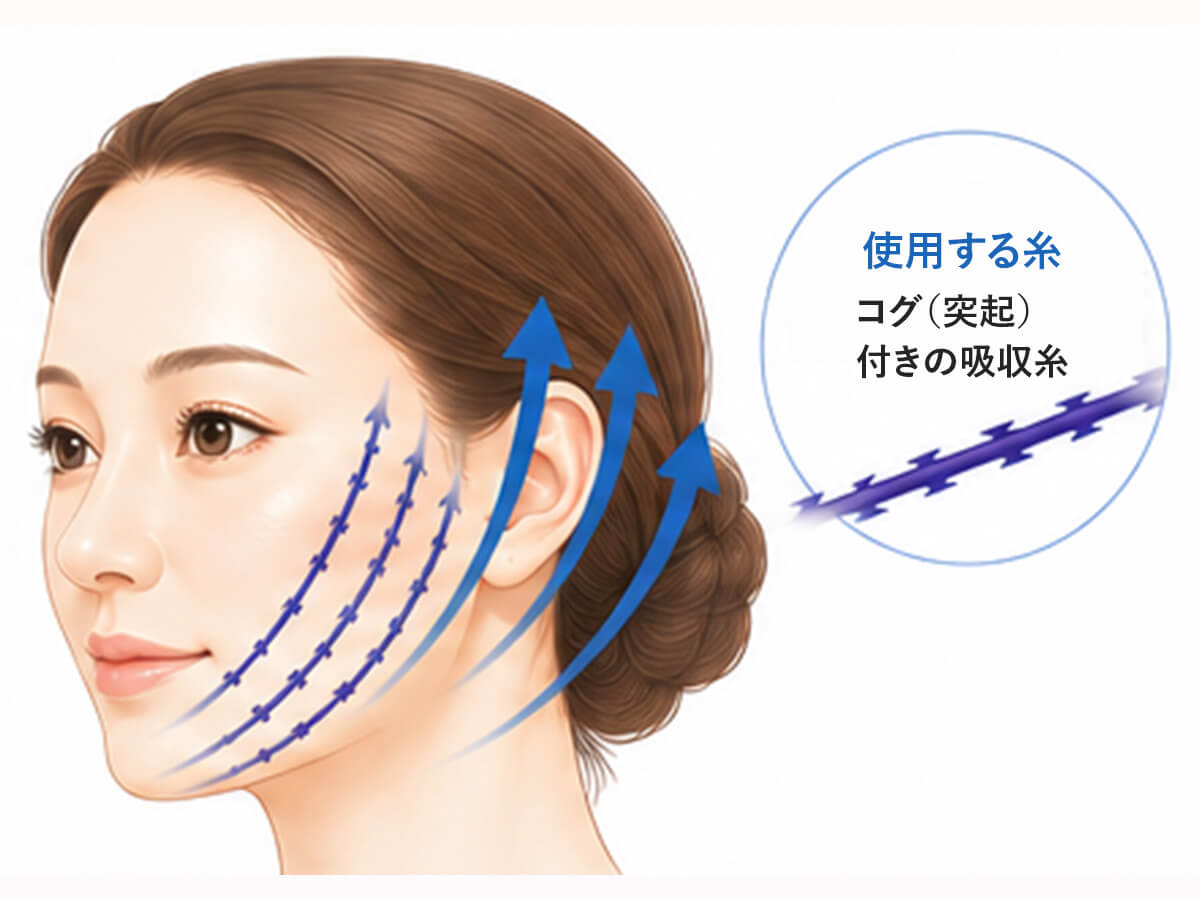 糸リフトイラスト