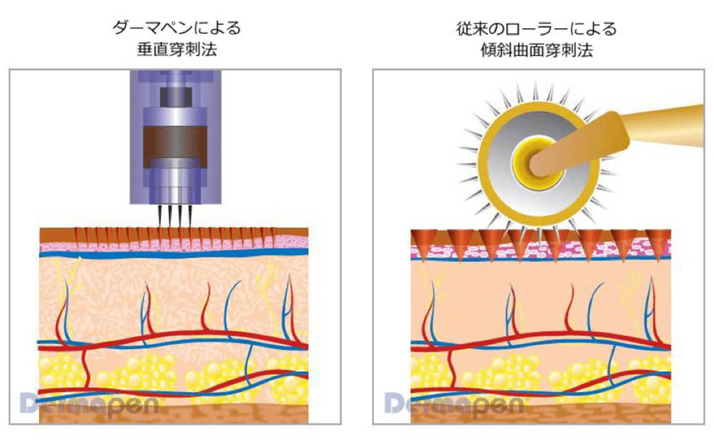 ダーマローラーとの違いイラスト