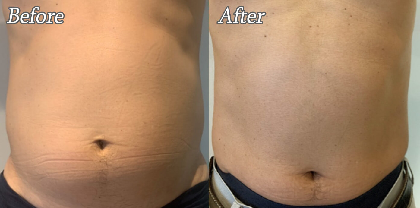 ニューロン施術後の症例写真01