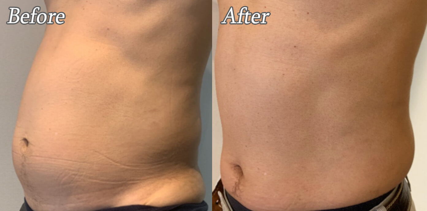 ニューロン施術後の症例写真02