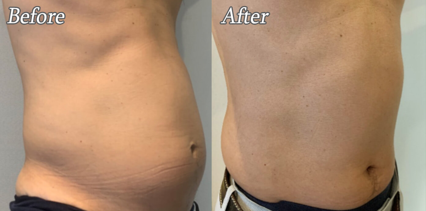 ニューロン施術後の症例写真03