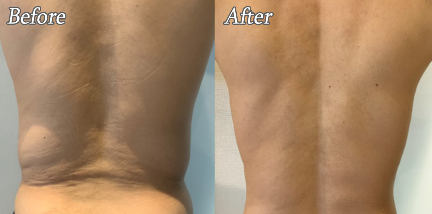 ニューロン施術後の症例写真03