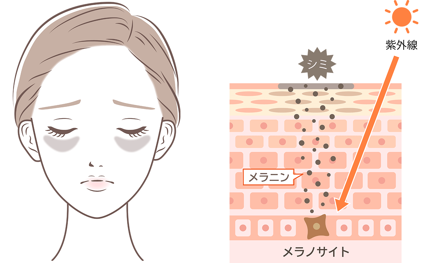 シミの原因イラスト