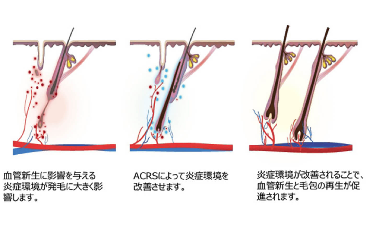 肌再生治療ACRSの仕組みイラスト