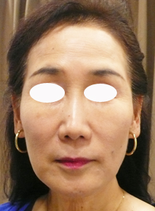 お顔の引き上げ治療1ヶ月後
