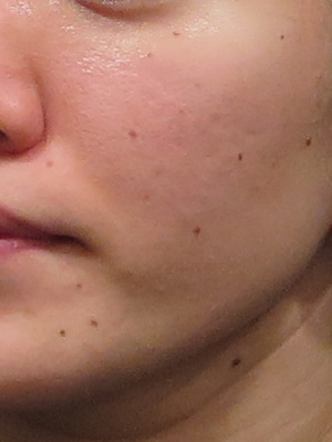 しみ治療 美容皮膚科女医のブログ Part 3