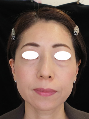目の下の袋状たるみ治療 By アグネス Agnes 美容皮膚科女医のブログ