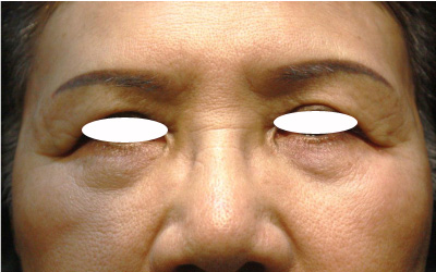 目の下のたるみレーザー治療