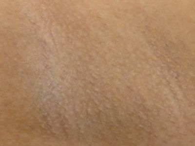 armpits_hair_removal_aft_up_20120219.jpg