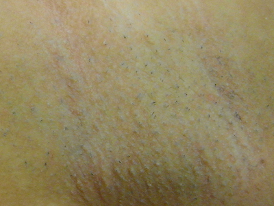 armpits_hair_removal_up_20120219.jpg