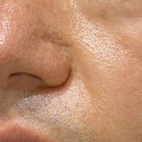 botox_aft_20120328.jpg