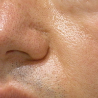 botox_aft_20120328.jpg