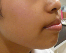 あごのシワ治療前横のサムネール画像
