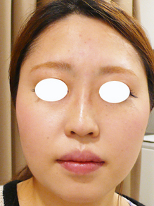 眉間から鼻筋にかけてのヒアルロン酸注射