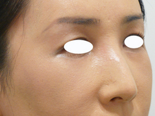 目の上のくぼみのサムネール画像
