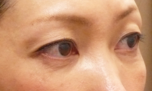 くぼみ目をヒアルロン酸注射で治療