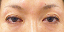 くぼみ目のヒアルロン酸治療
