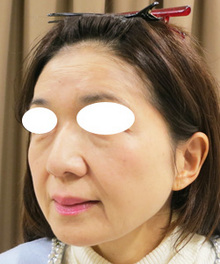 目の下のたるみと痩せをヒアルロン酸で治療のサムネール画像