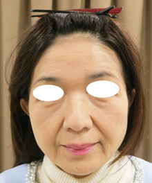 頬のたるみ治療後の写真のサムネール画像