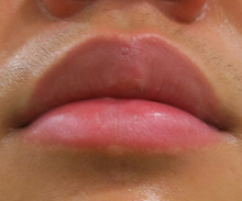唇のほくろレーザー治療後の写真