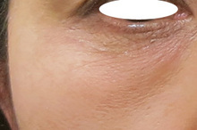 目の下のくまをPRPで治療のサムネール画像
