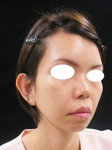 ビスタシェイプによる小顔治療
