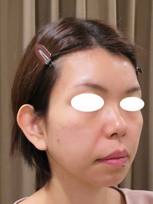 顔のたるみ治療前の写真