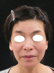 視線を真ん中に集める若返り術