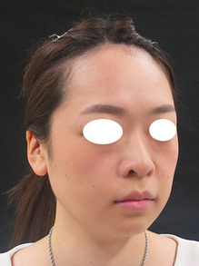 若い人の顔のたるみ