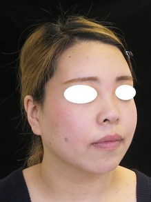 鼻を前に出すヒアルロン酸治療後の写真
