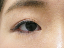 目のキワのほくろレーザー除去後の写真のサムネール画像