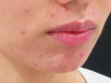 acne_rt_201706.jpg