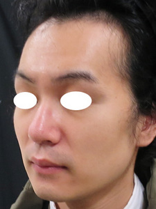 男性の顔のたるみ