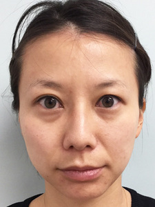 治療前の顔のサムネール画像