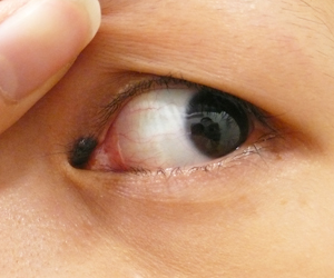 目のキワキワのホクロ治療