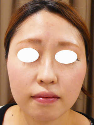 眉間から鼻筋にかけてのヒアルロン酸注射 美容皮膚科女医のブログ