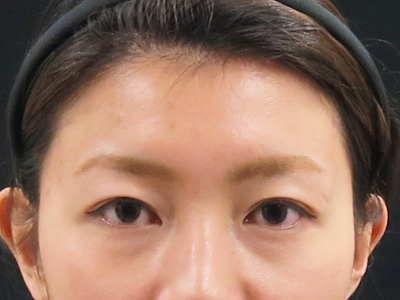 眉間と額と目尻のボトックス後の写真