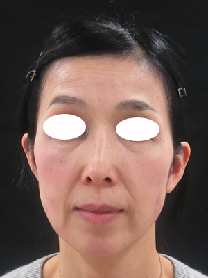 コメカミ おでこの凹みによる顔の変化 美容皮膚科女医のブログ