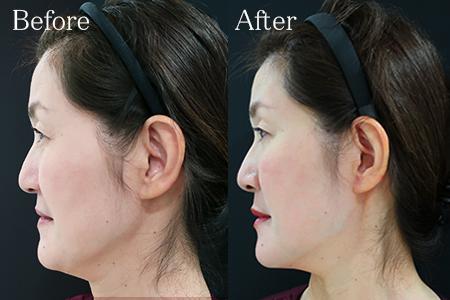 ヒアルロン酸注射後の顔のたるみ改善