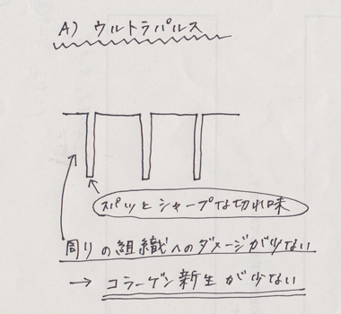 フラクショナルレーザーの種類　その２