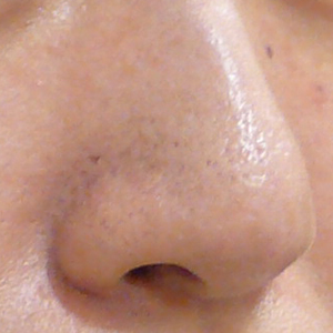 鼻の毛穴開きレーザー治療