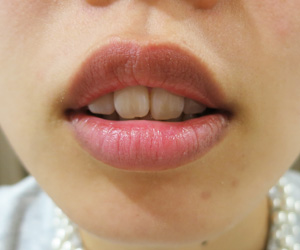 唇のほくろレーザー治療１週間後の写真