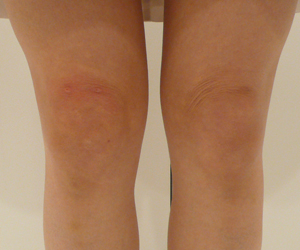 kneewrinkle_after_oneside_up_20121024.jpg