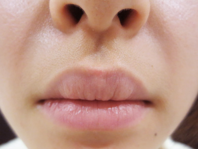 唇のほくろレーザー除去後の写真