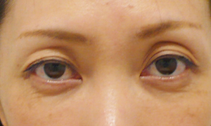 くぼみ目の治療