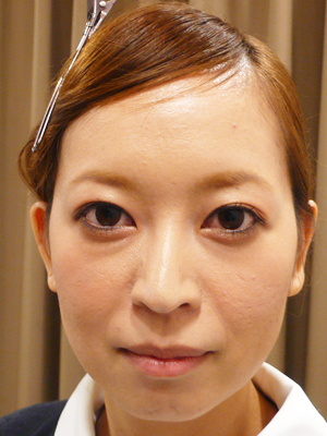 目の下のくまがスッキリ 美容皮膚科女医のブログ