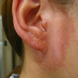 metalallergy_20110508.jpg