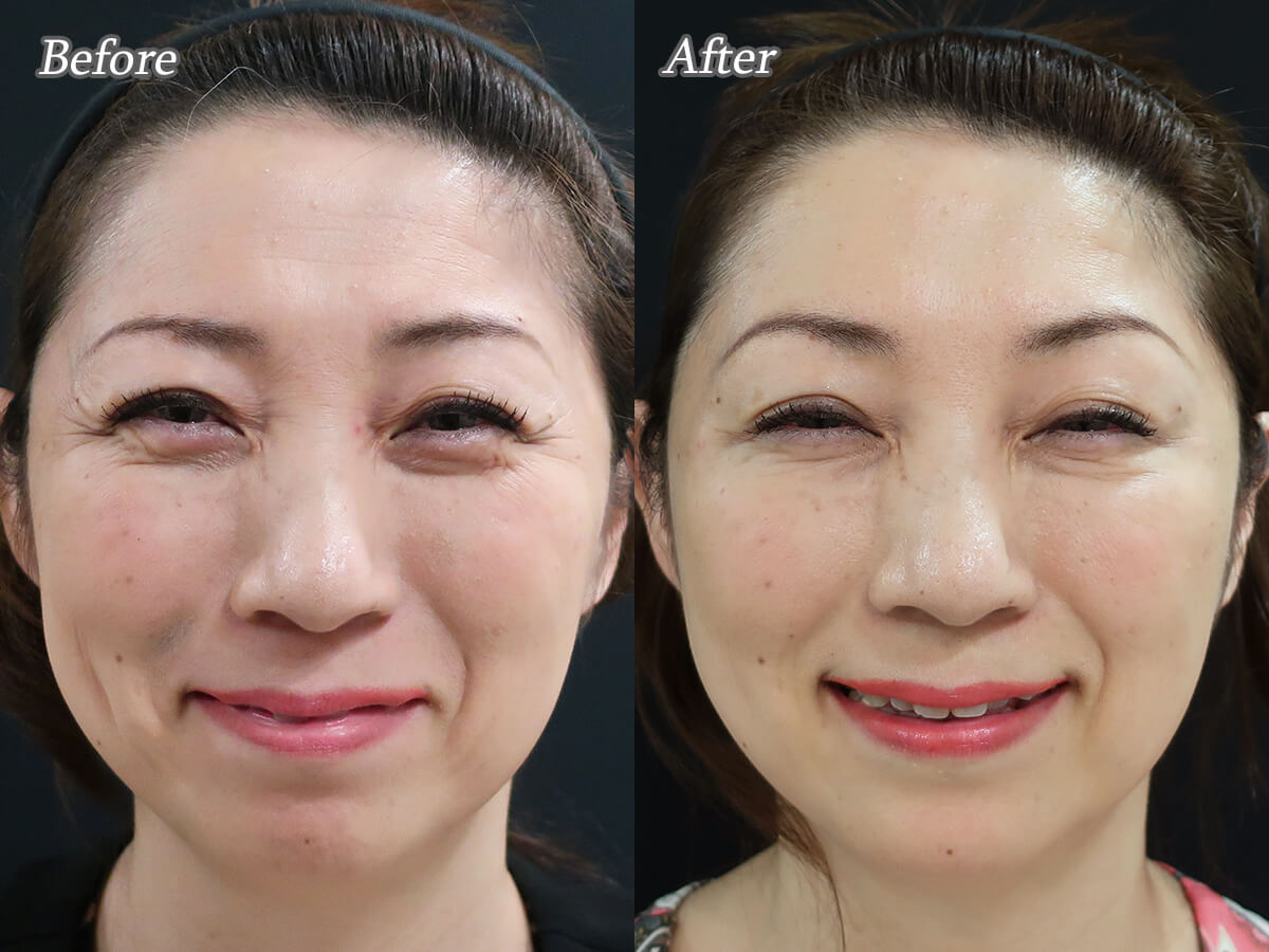 注意すべき副作用