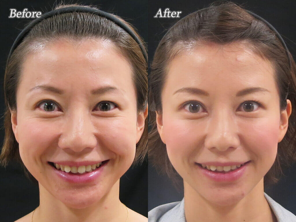 ボトックスの仕組み