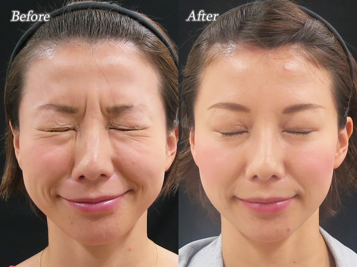 ボトックス後のフライング